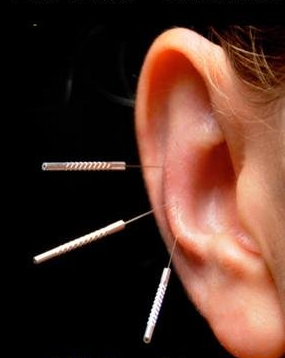 How Ear Acupuncture Helps Treat Addiction » Columbus ...